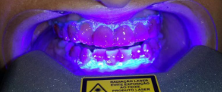 Imagen de proceso de blanqueamiento de dientes