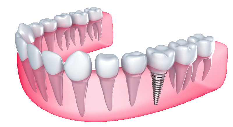 Imagen de proceso de implante.